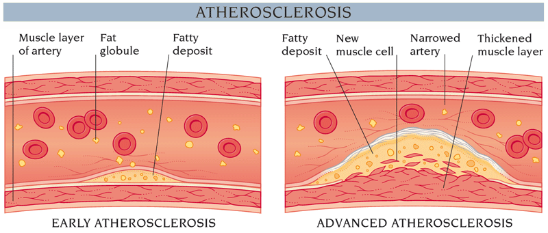 atherosclerosis