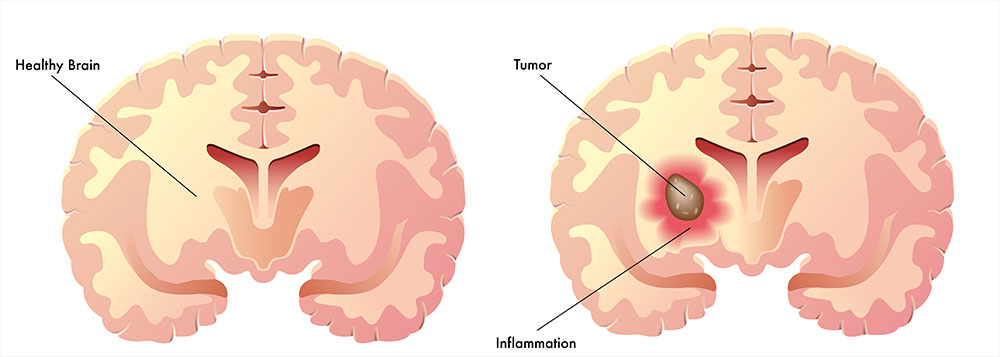 brain tumor