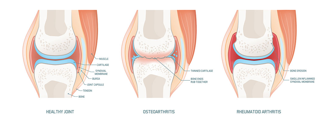 Osteoarthritis and Rheumatoid arthritis