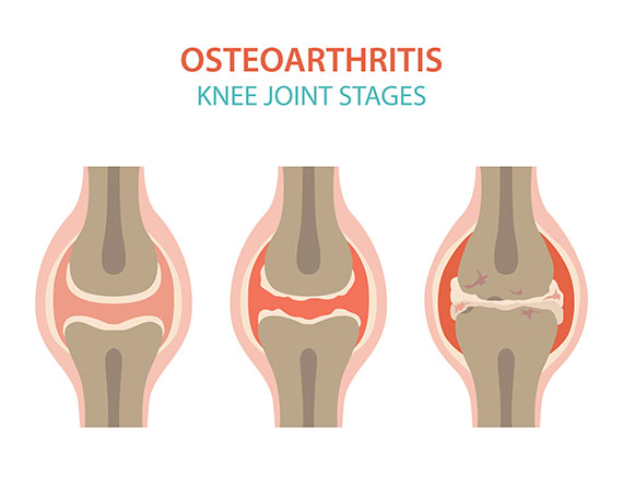 osteoarthritis